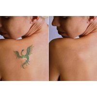Laser Tattoo Removal - Up to 6 Sessions at LBL Aesthetics and Laser Ltd, Chelmsford | Wowcher